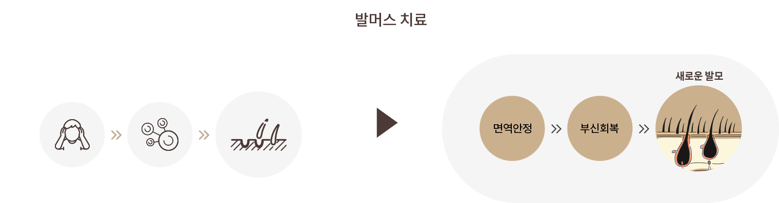 원형탈모 회복 과정